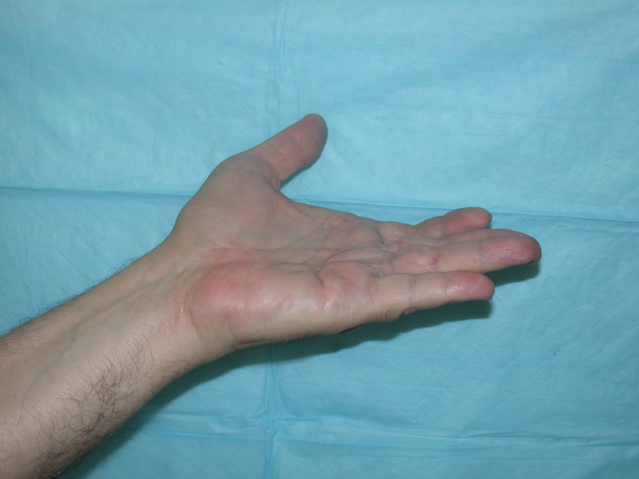 Dupuytren's contracture After