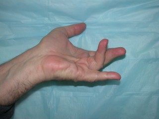 Dupuytren's contracture Before